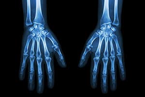 insurance, customer injury X-ray of hands